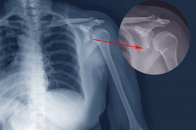X-ray image of dislocated joint, highlighting displaced bone (motor vehicle accident injuries, dislocated joint diagnosis).